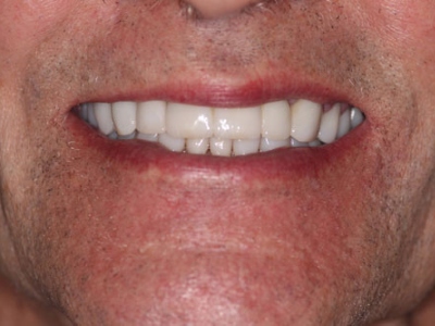 Full Mouth Reconstruction Bermuda Dunes, California - Palm Desert Dental