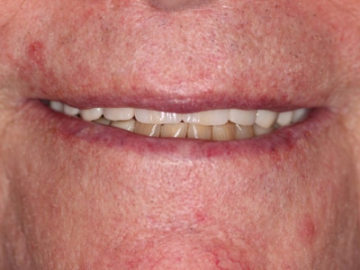Full Mouth Reconstruction Palm Desert