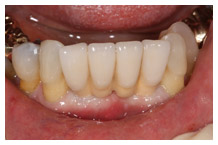 Close-up of natural-looking dental crown restorations on upper teeth in smile view.