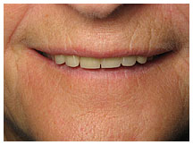 Close-up of person's smile showing teeth and gums for dental assessment or cosmetic dentistry evaluation.