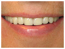 Close-up of a person's smile showing teeth and lips in a dental care context.