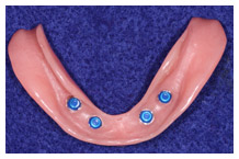Dental implant model displaying four blue titanium implants on pink gum-colored base against blue backdrop.