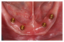 Dental implants in lower jawbone showing four gold abutments placed in gum tissue.