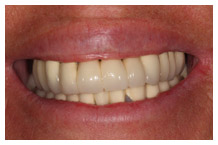 Close-up of a person's smile showing teeth after cosmetic dental treatment or whitening.