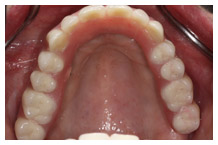 Overhead view of upper dental arch showing healthy aligned teeth and pink gum tissue.