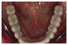 Intraoral view of upper dental arch showing natural teeth alignment and oral cavity health.