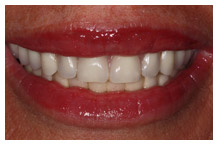 Close-up of a person's smile displaying white, healthy teeth and pink gums in a dental context.