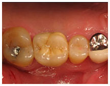 Four teeth displaying various stages of decay and dental restoration, clinical dental setting.