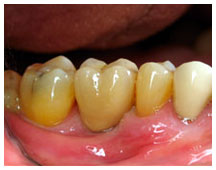 Close-up of discolored teeth showing yellow and brown staining on gum tissue in dental setting.