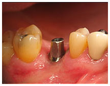 Dental implant procedure showing tooth restoration stages with crown placement on gum tissue.