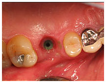 Dental implant procedure showing tooth extraction site and adjacent teeth in oral cavity during treatment.