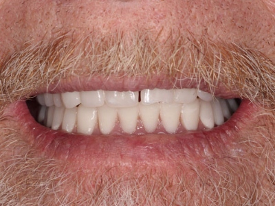 Featured image for “Upper Dentures Palm Desert, California”
