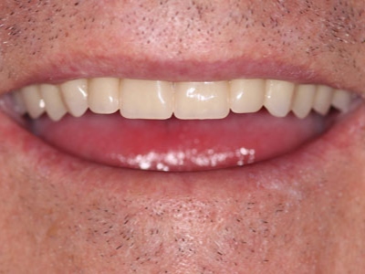 Featured image for “Upper Dentures Rancho Mirage, California”