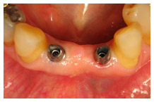 Dental implants in lower jaw showing titanium posts for tooth replacement procedure.