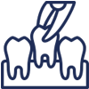 Dental implant procedure illustration showing tooth replacement between two natural teeth.