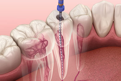 Dental root canal procedure illustration showing tooth cross-section with endodontic treatment visualization.