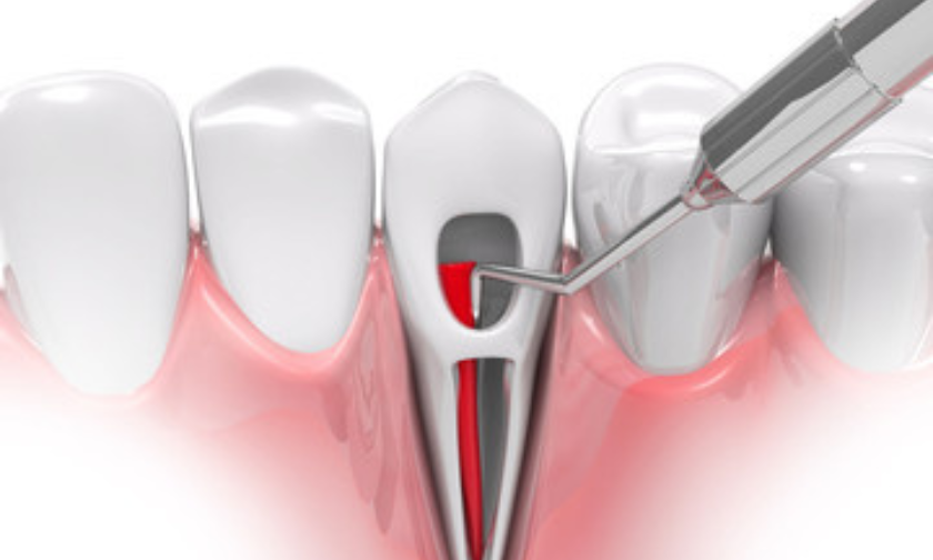 Root Canal Treatment