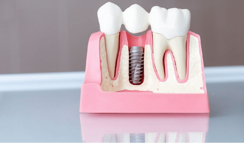 Dental implants
