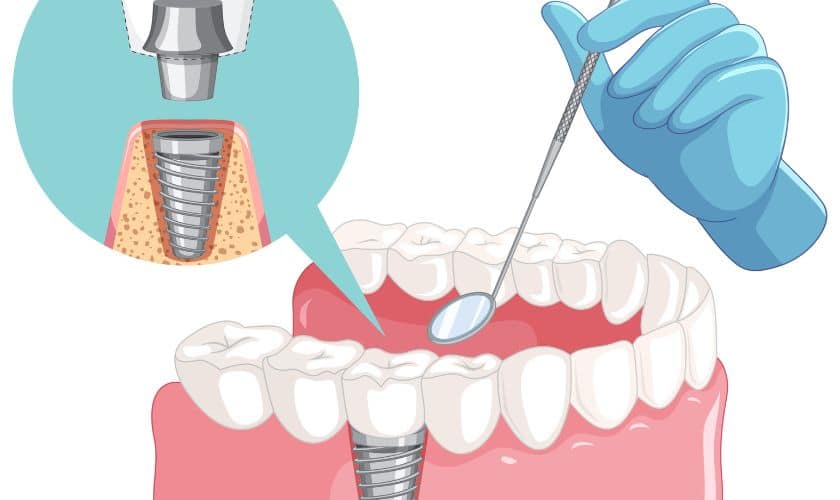 Dental implant procedure diagram showing tooth replacement with implant, abutment, and crown placement.