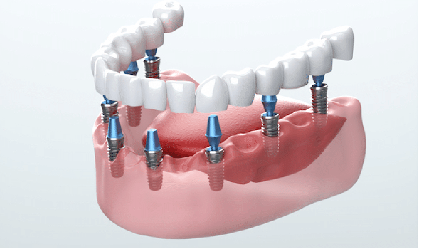 Digital illustration of dental implants anchored in jawbone with prosthetic teeth model.