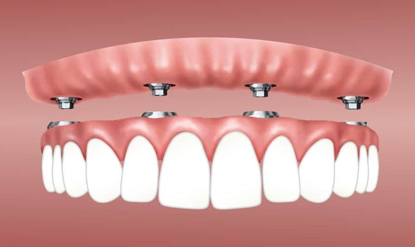 Featured image for “Teeth In An Hour: Revolutionary Step For Getting Dental Implants”