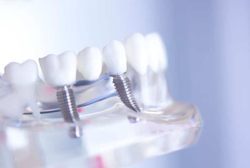 Featured image for “Transform Your Smile With Porcelain Veneers – Unleash Your Radiance!”