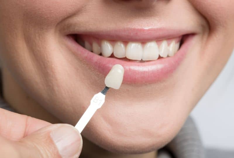 Featured image for “Natural Vs. Artificial Look: Which Veneer Is Right For You?”