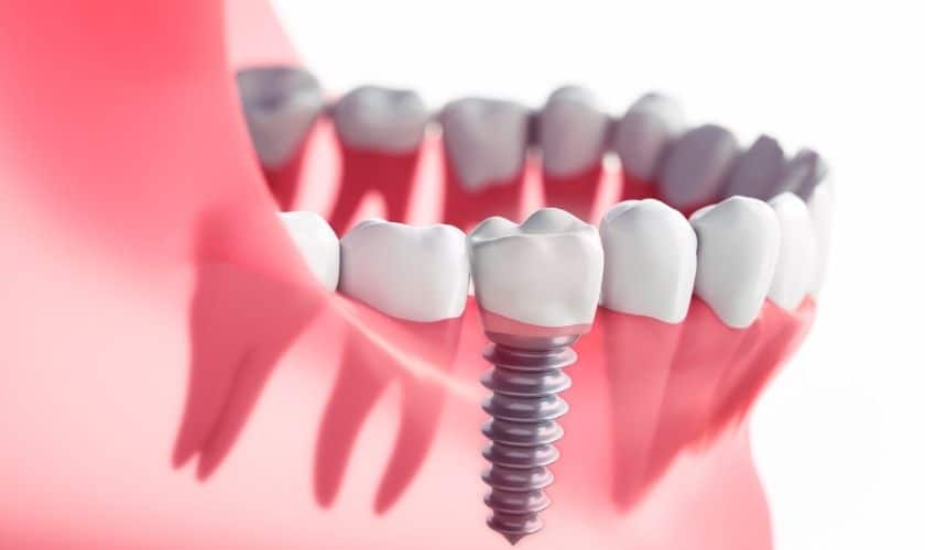 Patient Stories: Real-Life Success With Dental Implants In Palm Desert