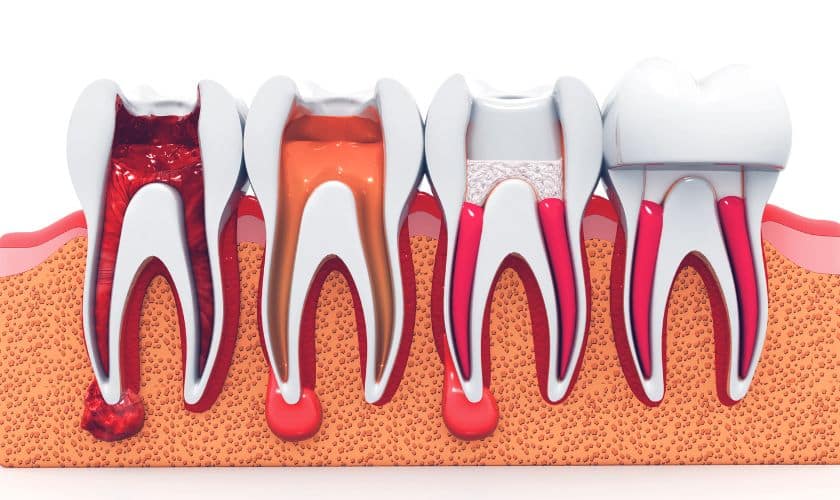 Featured image for “New Year, New Smile: The Benefits Of Root Canals For Dental Health”