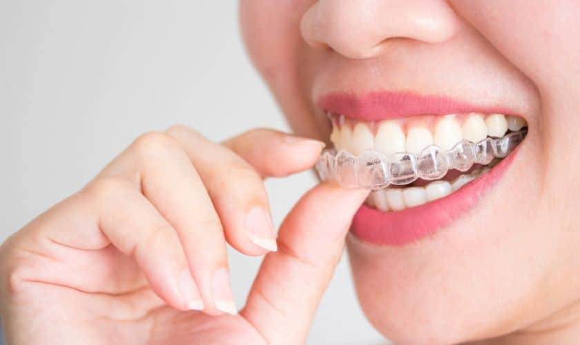 Featured image for “Exploring the Benefits of Invisalign Treatment in Palm Desert”