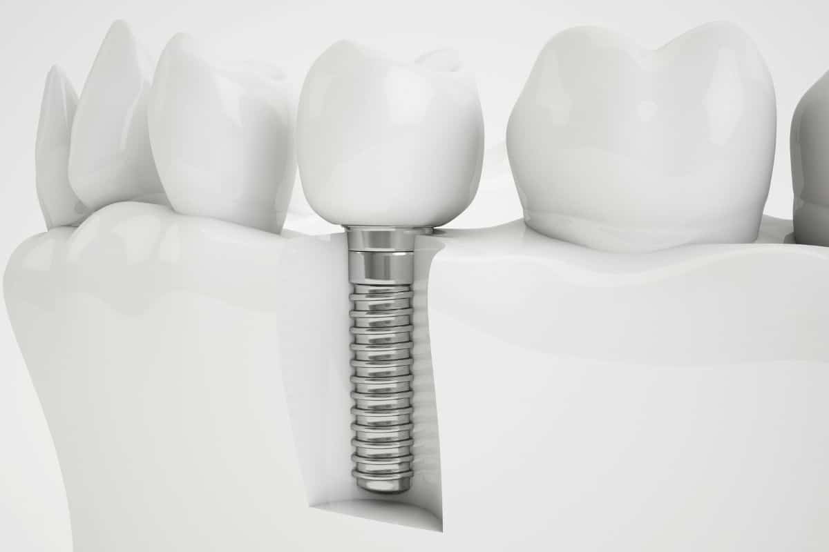 Featured image for “Can You Replace All Missing Teeth in One Day? Everything You Need to Know”