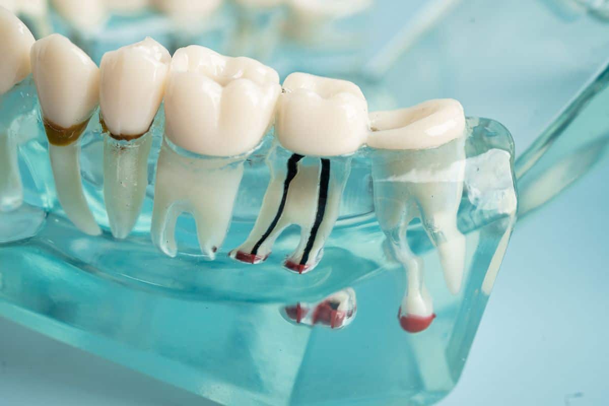Featured image for “5 Questions to Ask Your Dentist Before Getting a Root Canal”