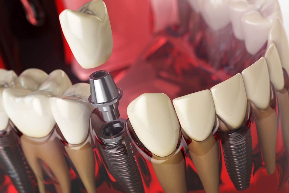 implant dentist palm desert