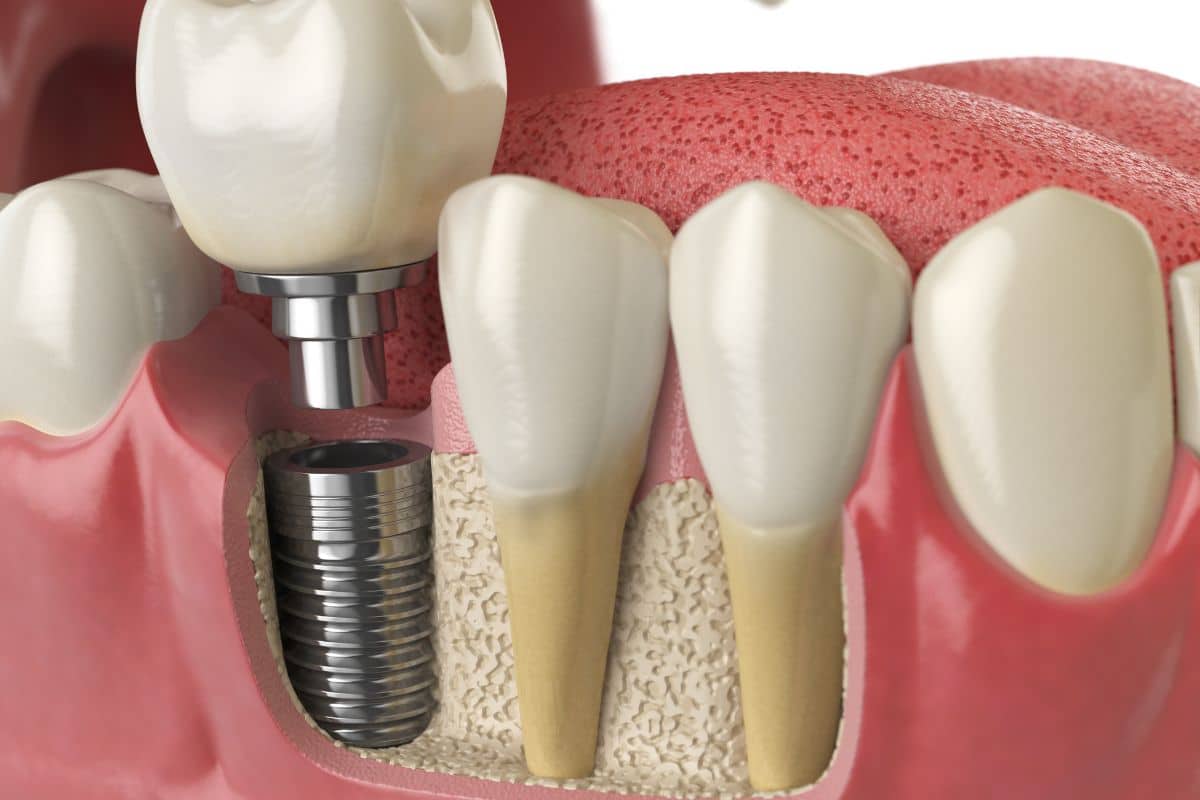 Dental implant model showing artificial tooth crown on metal screw next to natural teeth.