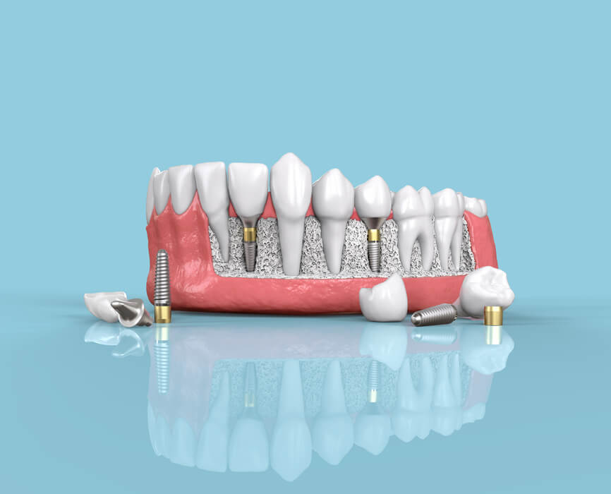 Dental implant model showing tooth restoration stages on pink gum model against blue background.
