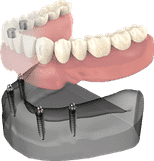 Dental implant model showing prosthetic teeth attachment on jawbone structure for implant dentistry education.