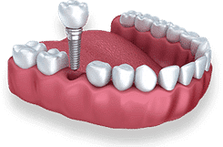 Dental implant model showing titanium screw fixture in synthetic gum with prosthetic tooth crown.