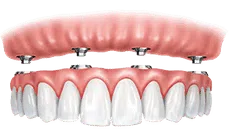 Dental implant crown restoration showing gum tissue and artificial tooth placement illustration.