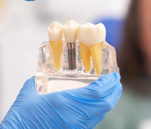 Dental professional holding dental implant model showing tooth structure and titanium screw component.