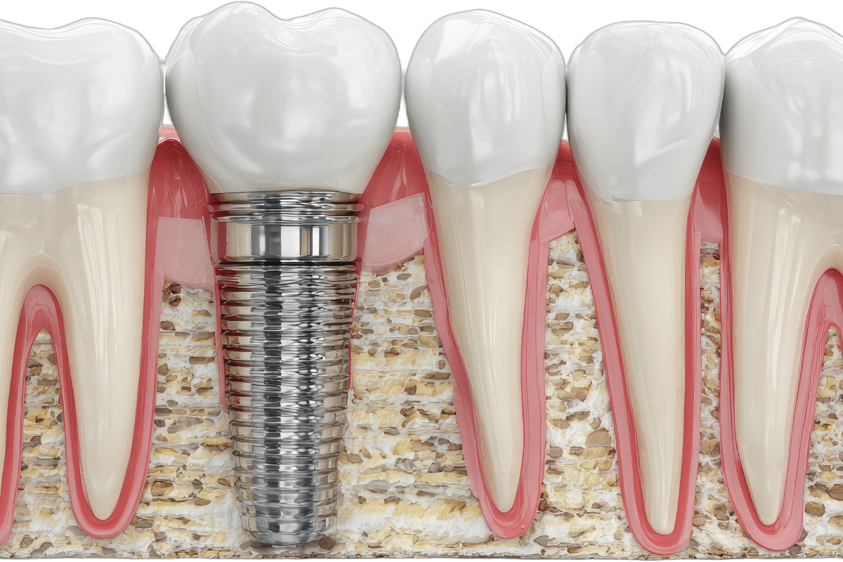 Dental Implant