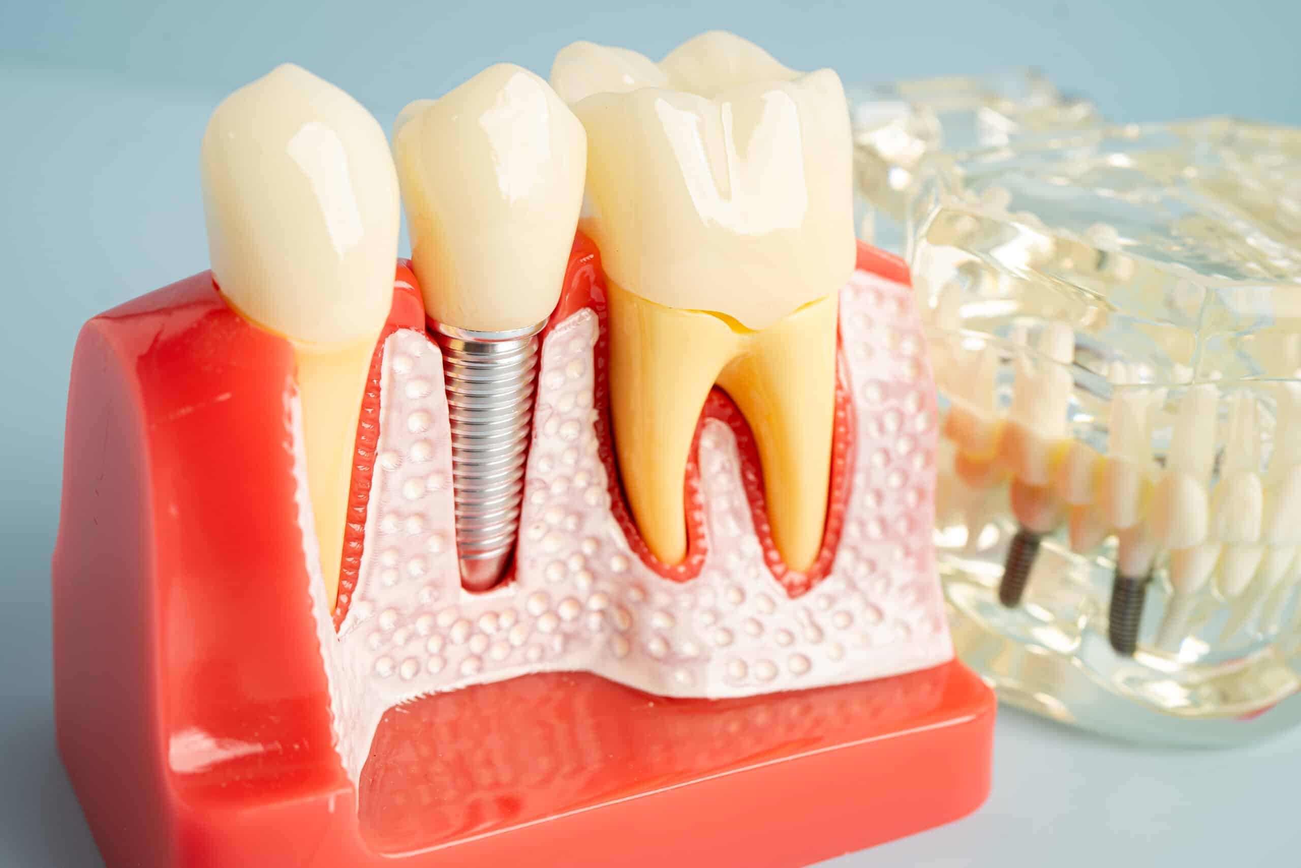 Featured image for “Why Bone Grafting Is Important for Successful Dental Implants”
