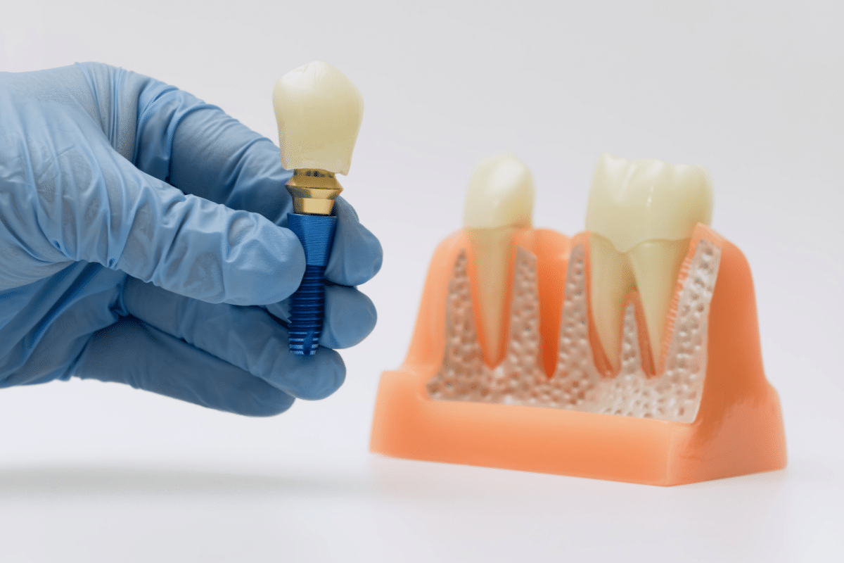 Featured image for “Can Dental Implants Fail, and What Are the Warning Signs?”