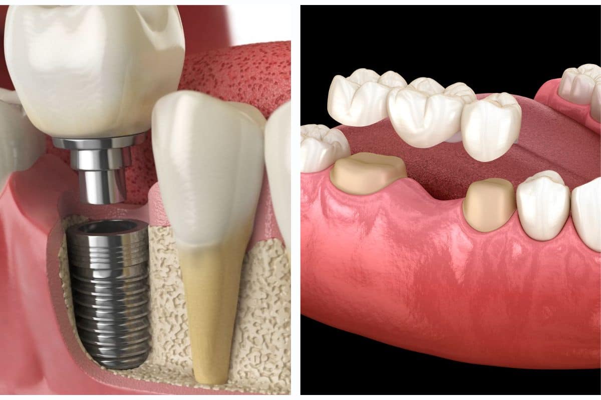 Featured image for “Dental Implant vs. Dental Bridge: Which Is the Better Choice for Missing Teeth?”