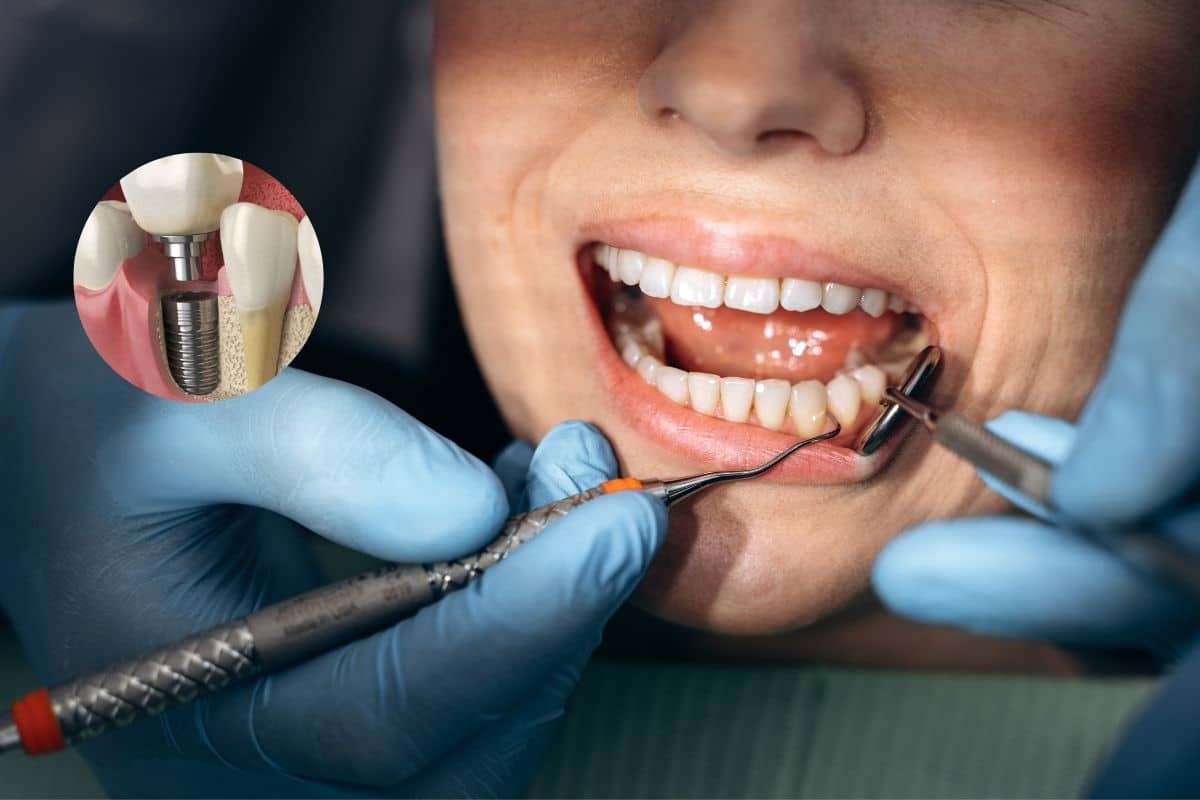 Featured image for “When Is Deep Cleaning Needed Before Dental Implant Surgery?”